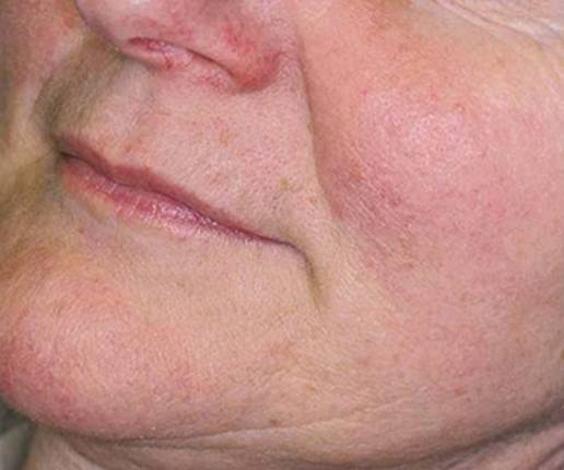 Hydrafacial