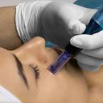 Microneedling